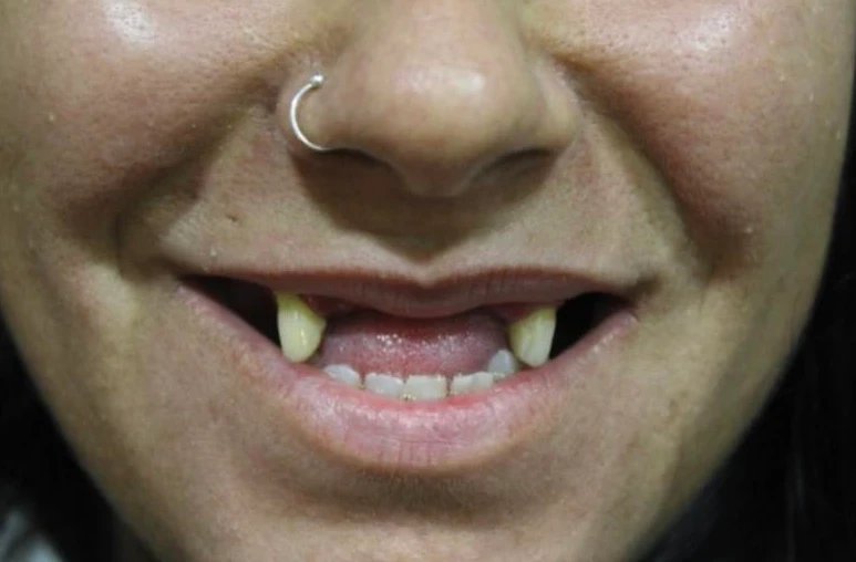 Antes